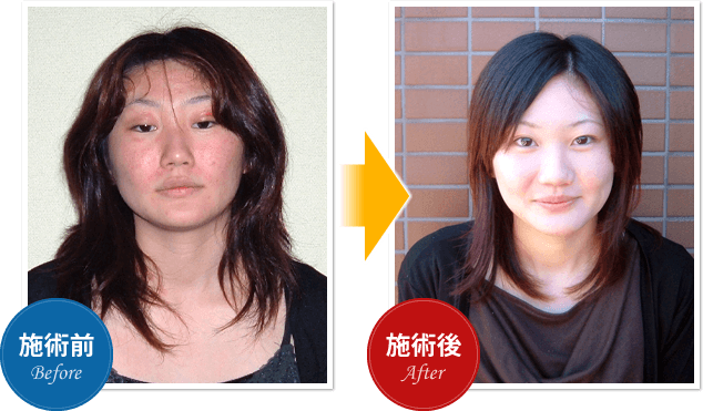 患者さま1(5か月後の効果)